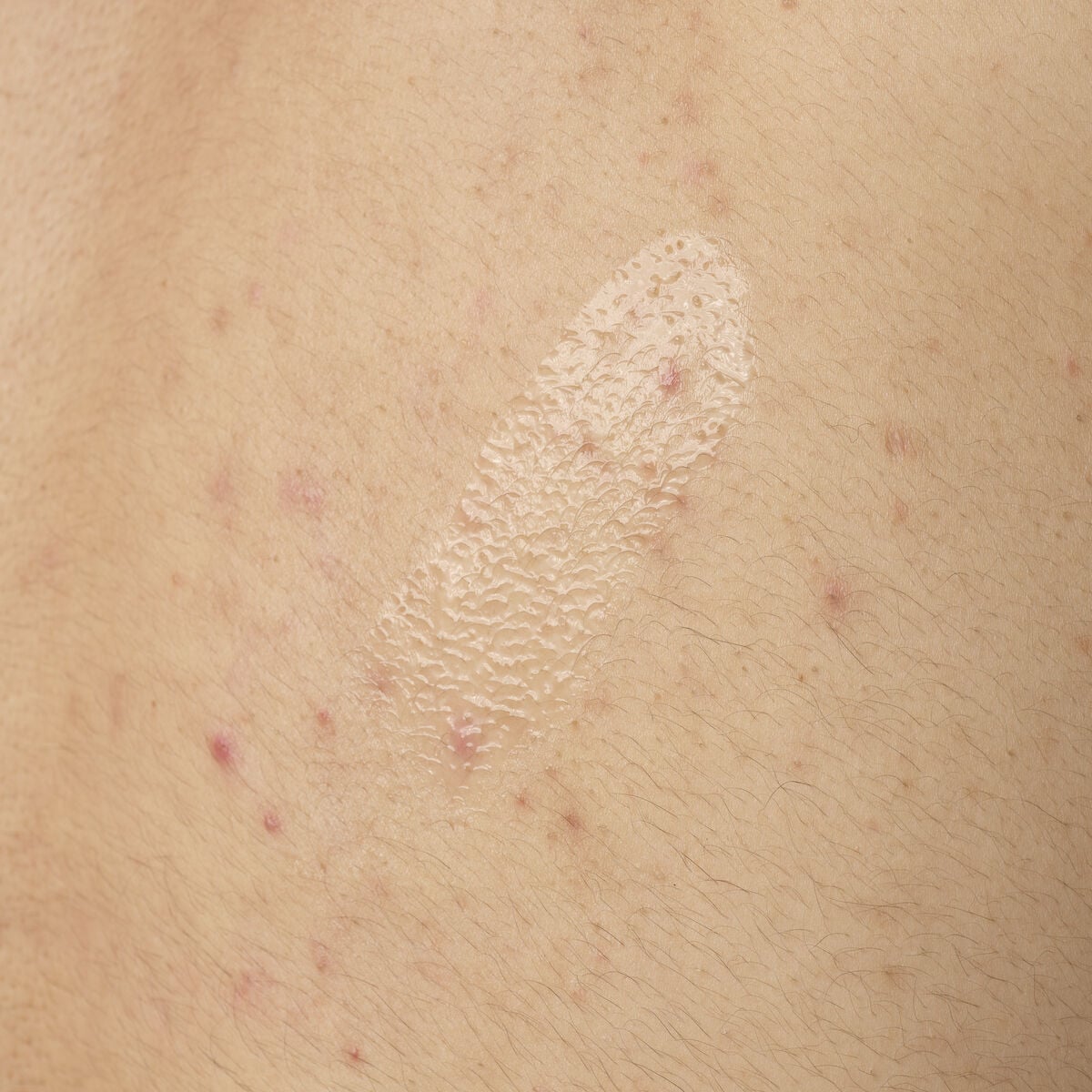 salicylic-acid-0-5-body-serum-n1 ORD-salicylic-acid-05-body-240ml-application.jpg