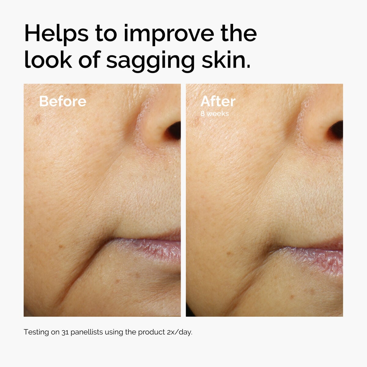 caffeine-3-escin-1-face-serum-x3 ord-caffeine-3pct-escin-1pct-face-serum-before-after-sagging.jpg