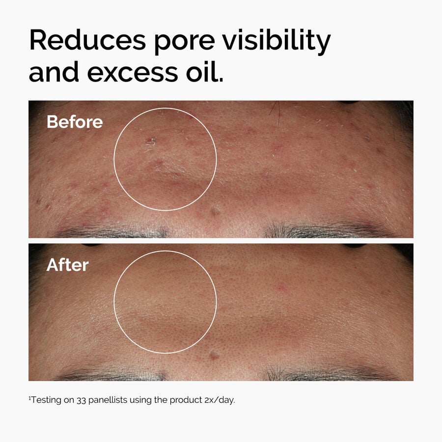 niacinamide-10-zinc-1-z3 ord-niacinamide-zinc-blemish-serum-before-after-pores.jpg