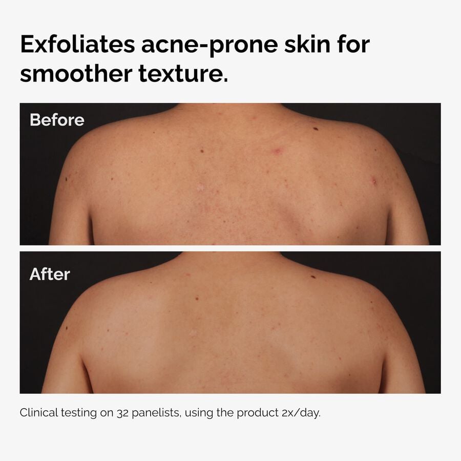 the-body-care-collection-h8 ord-salicylic-acid-body-serum-before-after-graphic-NA.jpg