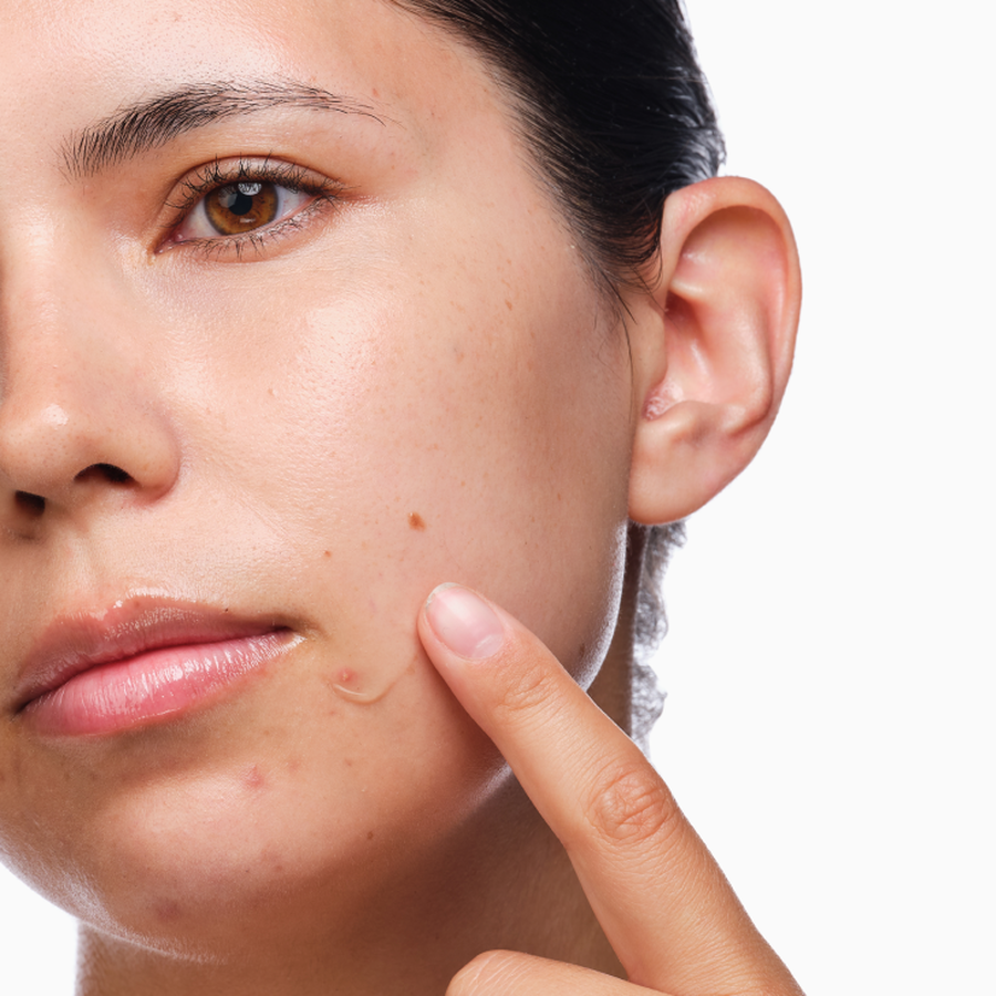 the-acne-set-f2 rdn-the-acne-set-application.png